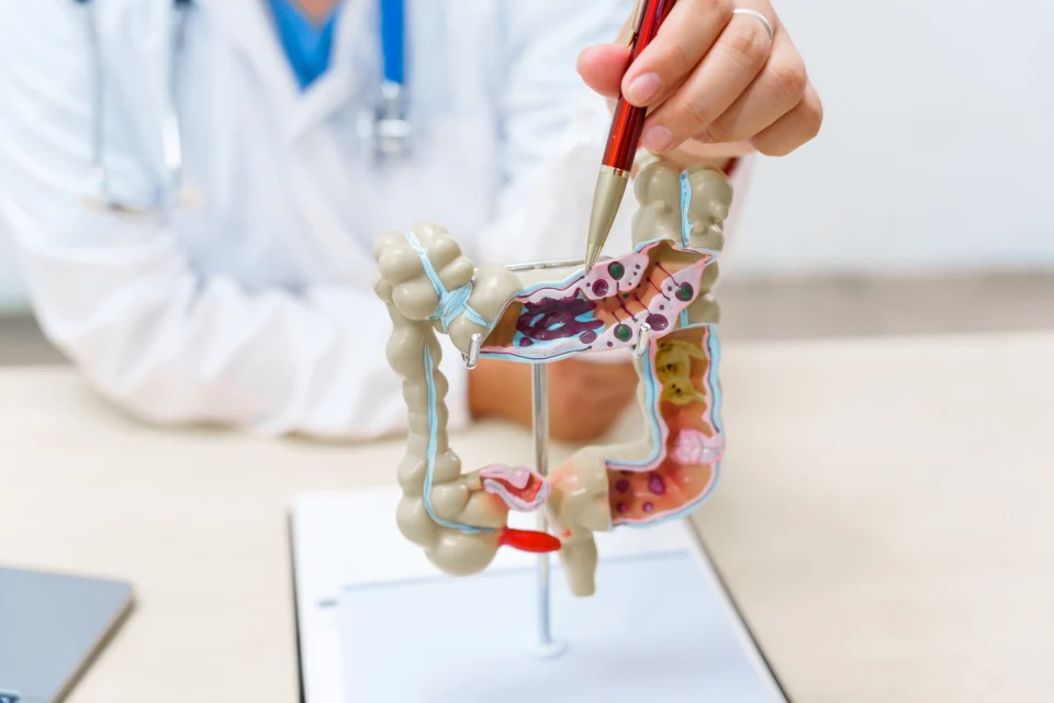 Reizdarmsyndrom – Ursachen, Symptome und Behandlungsmöglichkeiten